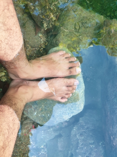 Immagine relativa al post intitolato Micosi da Spiaggia: Come Prevenirle e Curarle